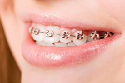 Orthodontics 101: Familiarizing Lingual Braces