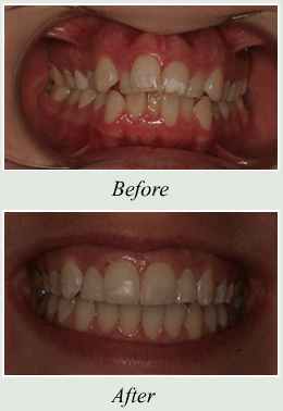 braces before and after